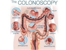 Colonic Hydrotherapy Devices 7